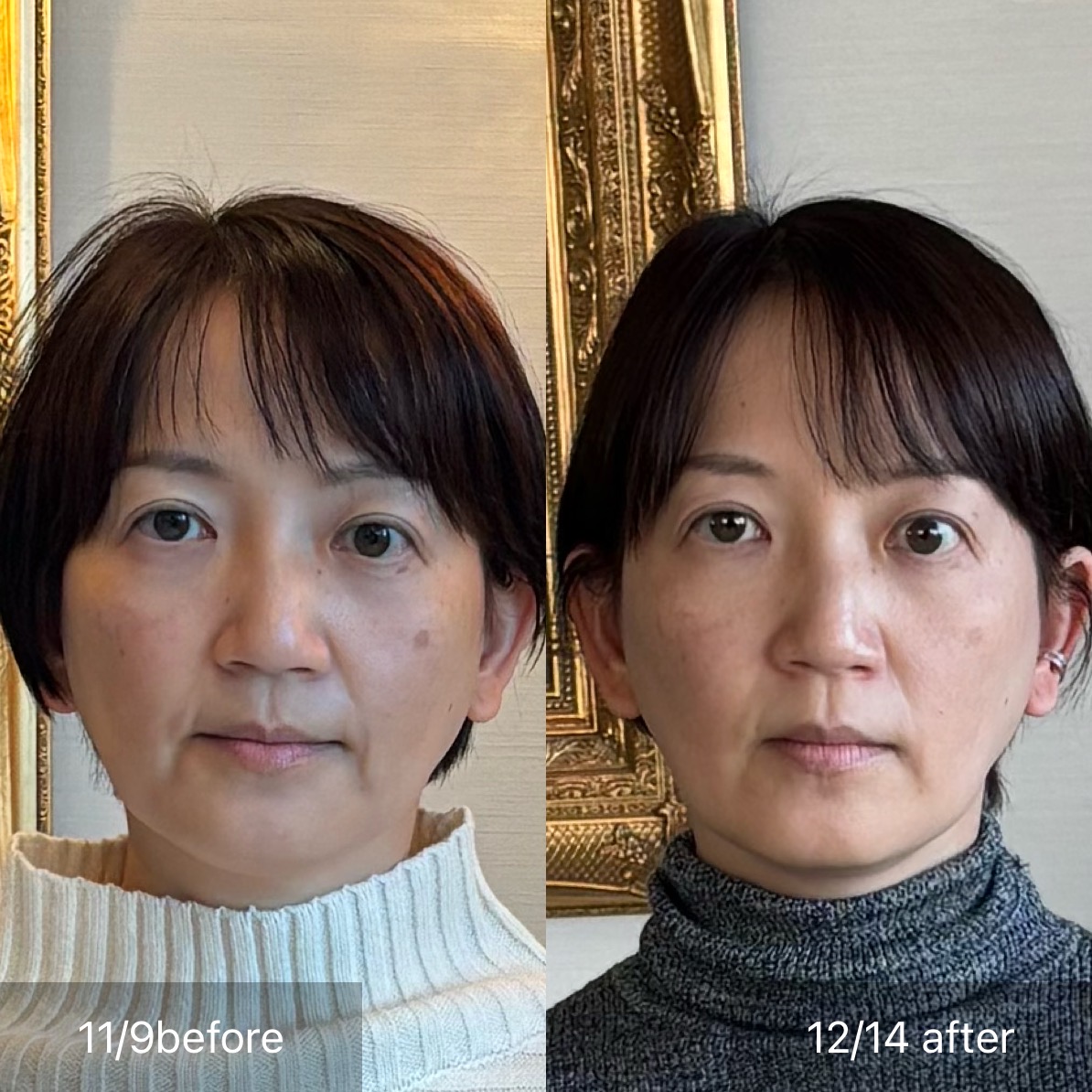 女性 お顔実例 ビフォーアフター